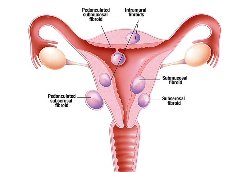 uterine-fibroids-fb-khanapure-sinhagad-road-pune